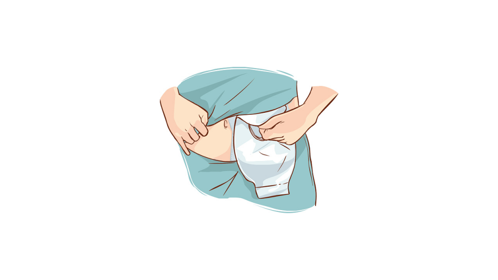 O que é uma colostomia? - Cirurgia do Aparelho Digestivo em Curitiba